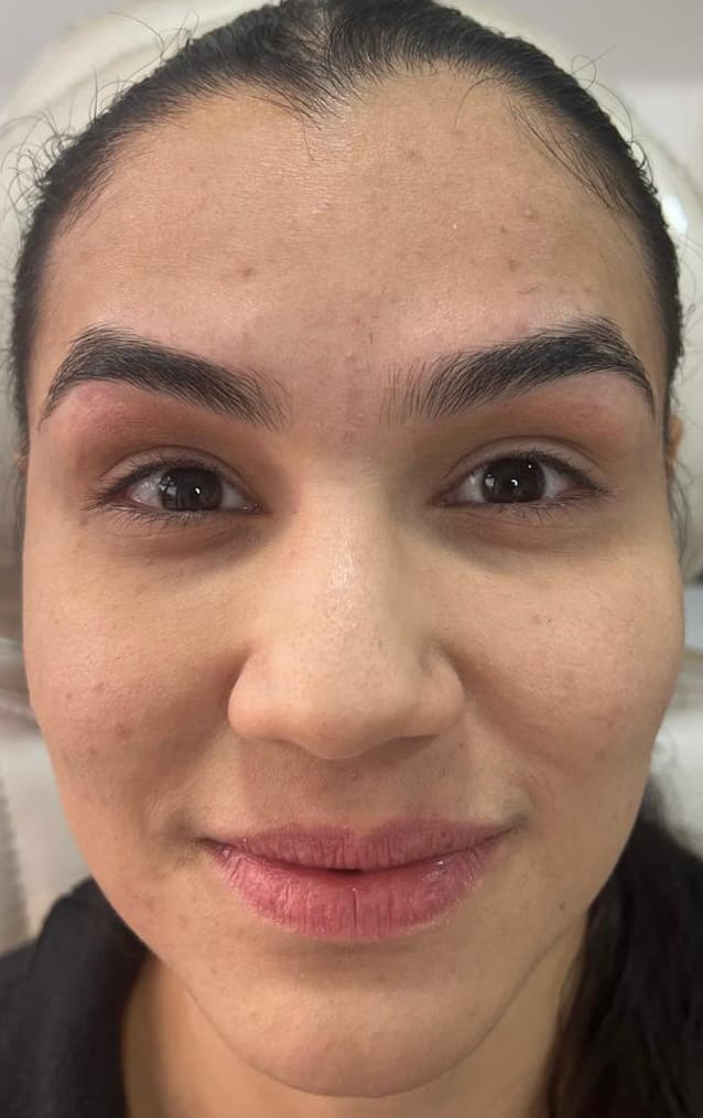 Botox e preenchimento facial dra brunna peixoto harmonização facial 2
