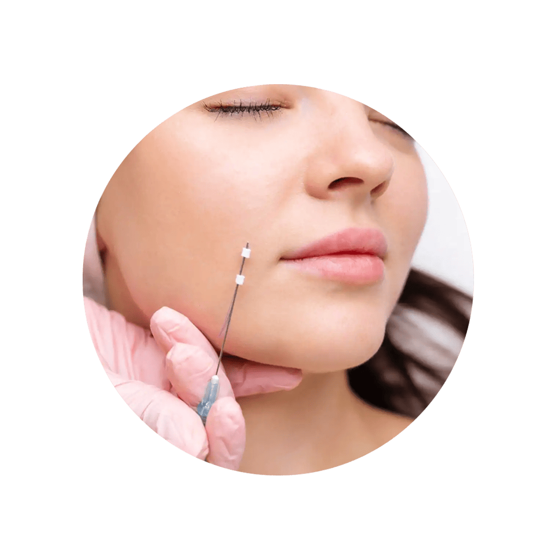 Imagem de aplicação de fios de PDO para lifting facial sem cirurgia