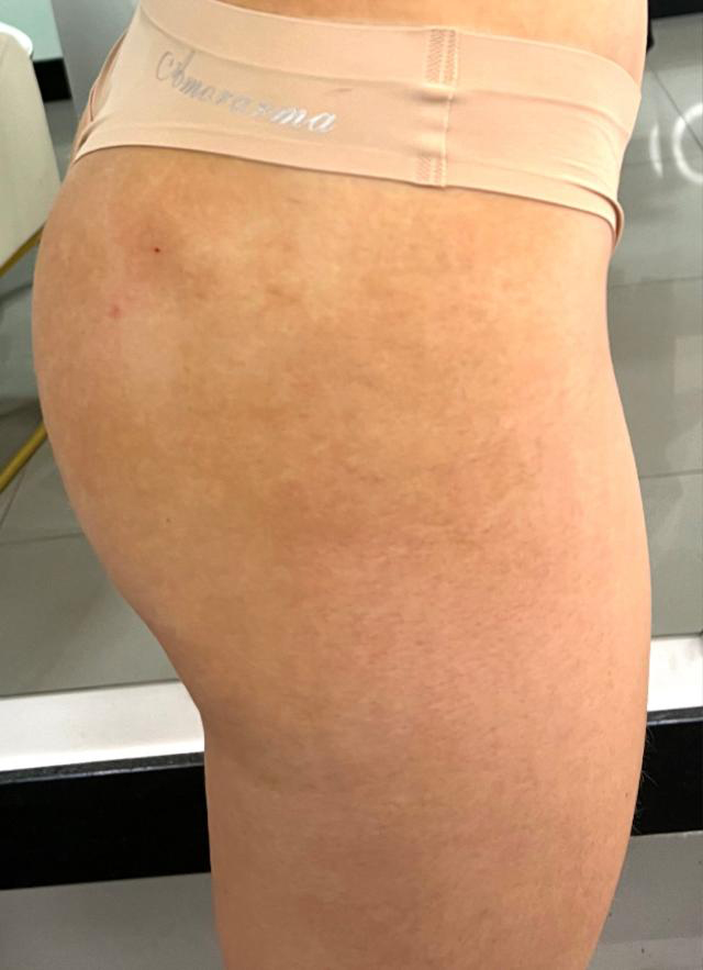 Preenchimento Gluteo harmonização corporal dra Brunna Peixoto Brasília DF 2
