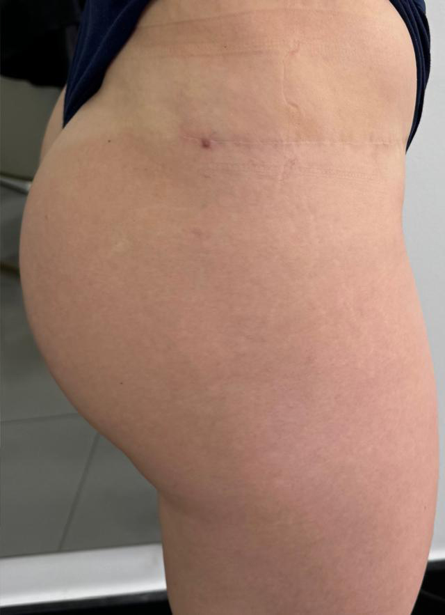 Preenchimento Gluteo harmonização corporal dra