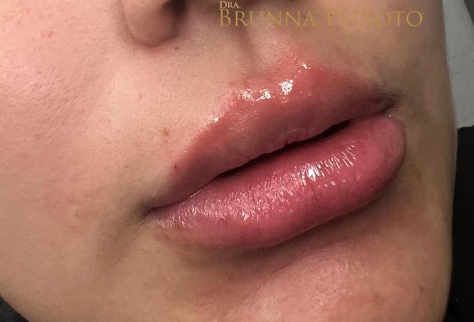Preenchimento labial Dra Brunna peixoto brasilia DF 2