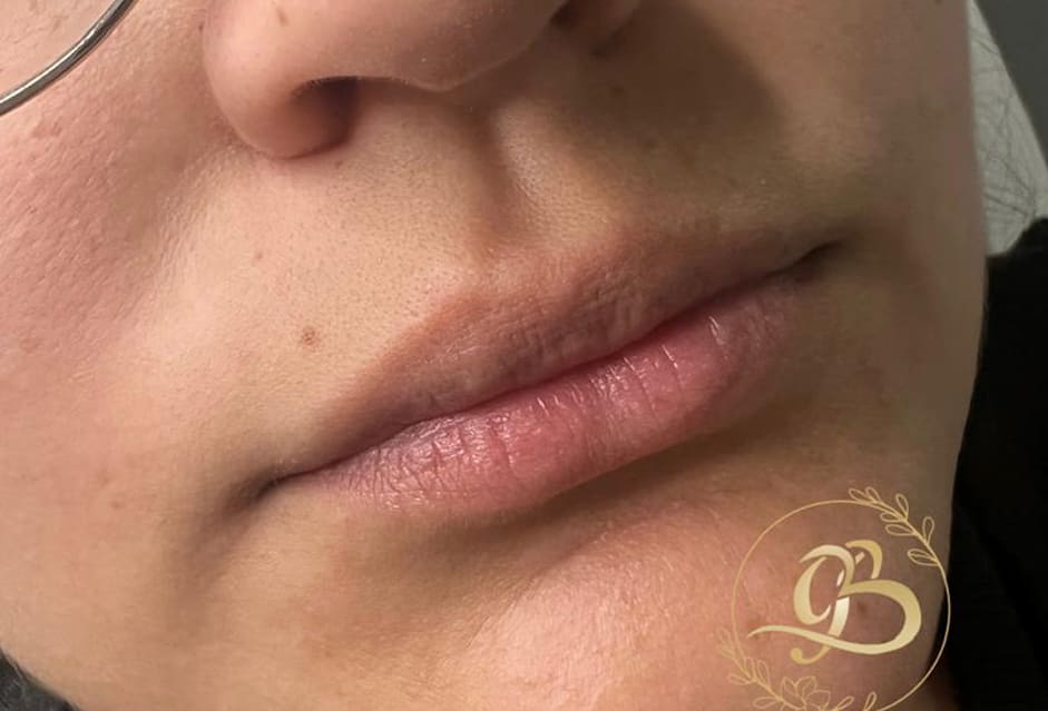 Preenchimento labial Dra Brunna peixoto brasilia DF