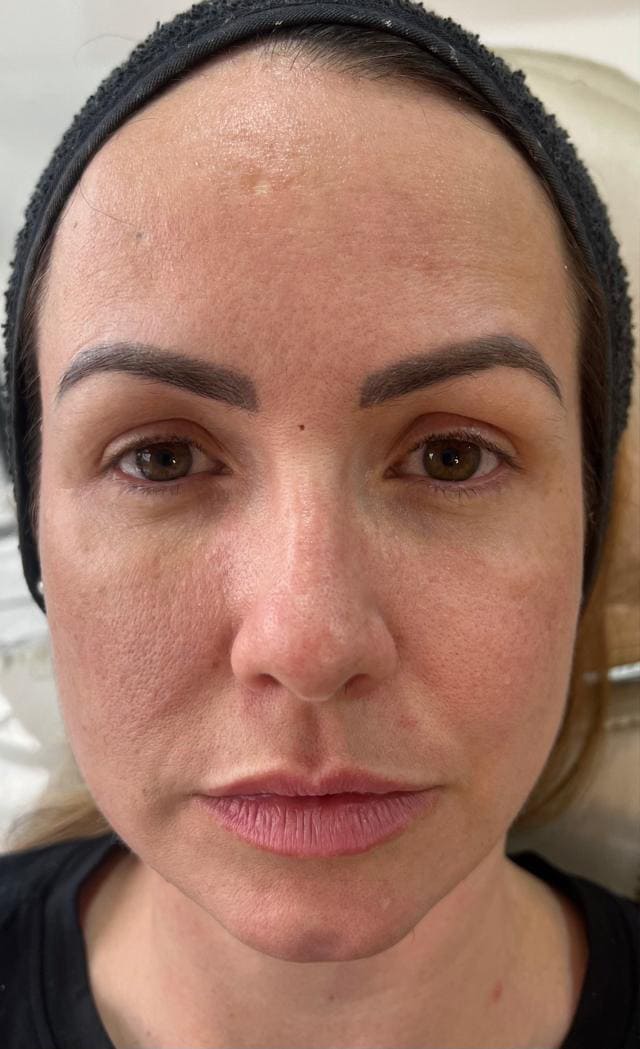 harmonização facial Dra. brunna peixoto