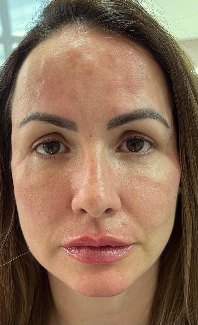 harmonização facial Dra